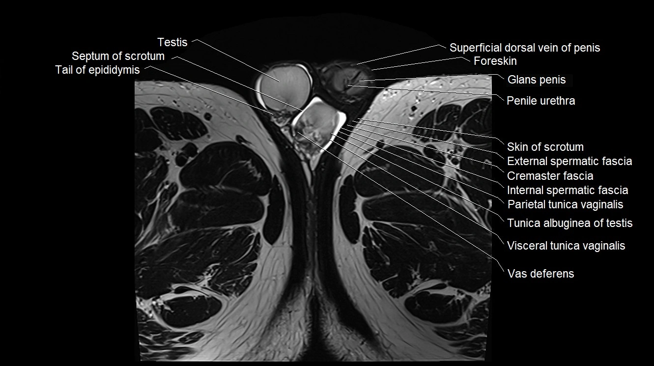 MRI 3T scrotum and penis axial cross sectional anatomy image 33.webp
